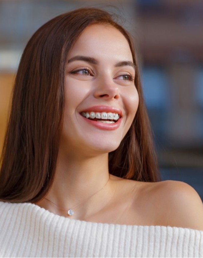 Fixed Braces