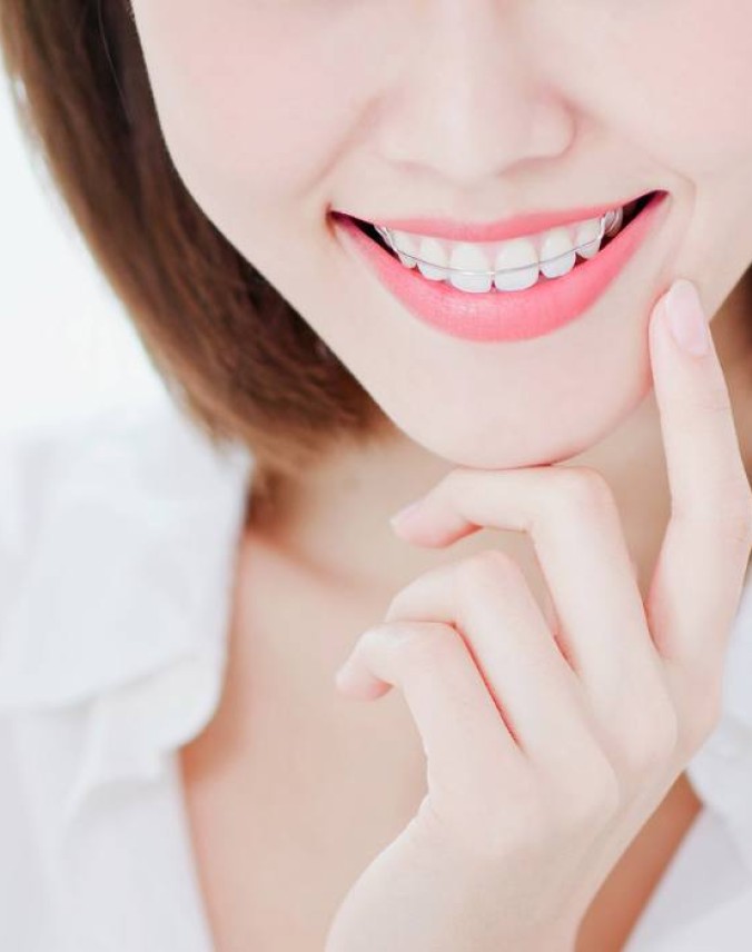 Removable Braces