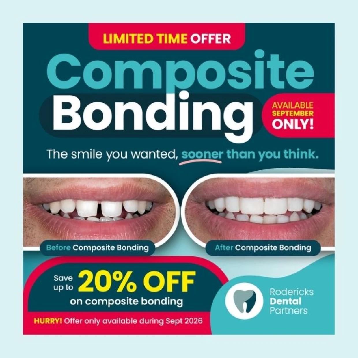 Composite bonding